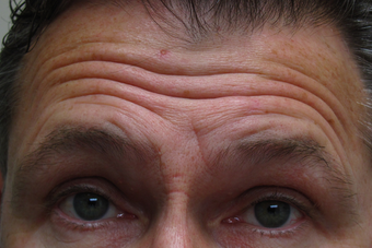 Botox for forehead lines before 1307499