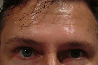 Botox for forehead lines after 1307499