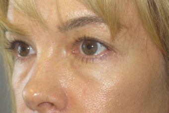 Lower lid fat prolapse and loss of midface volume before 1032182