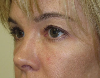 Lower lid fat prolapse and loss of midface volume after 1032182