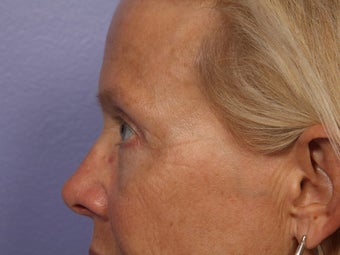Eyelid Surgery after 280872