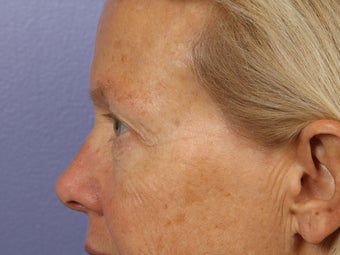 Eyelid Surgery before 280872