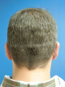 Otoplasty Ear Surgery - Male 818058