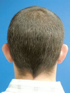 Otoplasty Ear Surgery - Male 818058