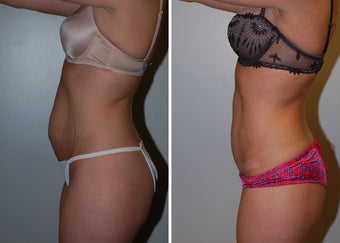 Abdominoplasty (Tummy Tuck) after 330696