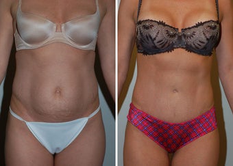 Abdominoplasty (Tummy Tuck) before 330696
