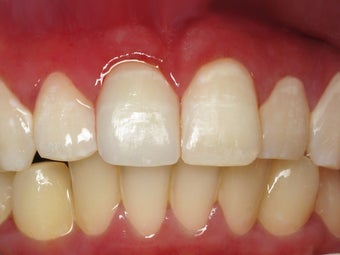 Porcelain Crown to Fix a Broken Tooth Before & After Photo after 996263