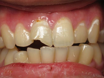 Porcelain Crown to Fix a Broken Tooth Before & After Photo before 996263