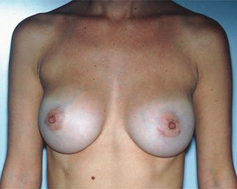 Breast Implant Correction after 281297