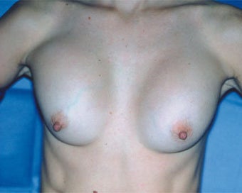 Breast Implant Correction before 281297