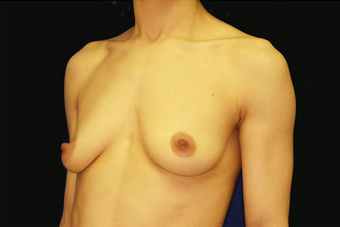 breast augmentation and mastopexy 391312