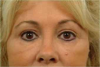 Upper and Lower Blepharoplasty after 386628
