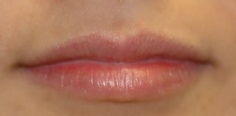 Juvederm in Lips before 871673
