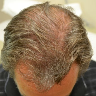 53 year old male before and after 1 year on Propecia after 892889