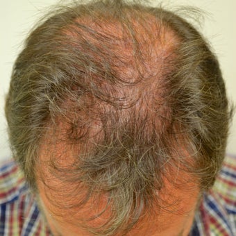 53 year old male before and after 1 year on Propecia before 892889