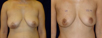 Minimally Invasive Scarless Breast Lift before 1197690