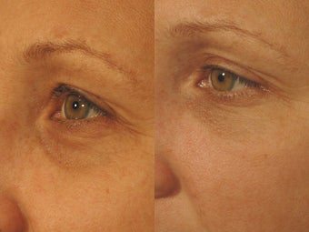 Tear Trough Before and After Pictures with Restylane for Tired Eyes before 1256632