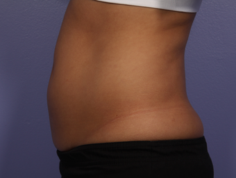 CoolSculpting by Zeltiq to Abdomen before 375546
