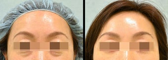 Lower Eyelid(Blepharoplasty) Surgery before 656881