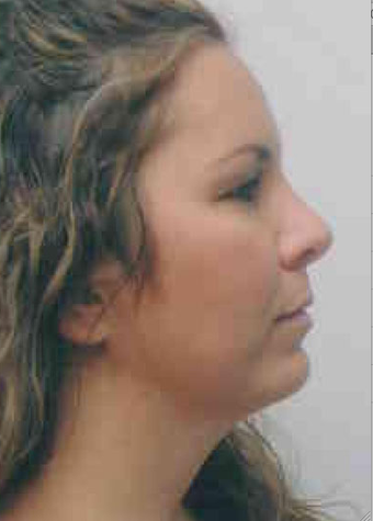 Chin Implant after 724313