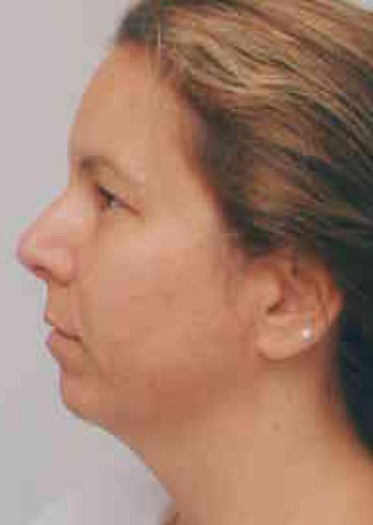 Chin Implant 724313