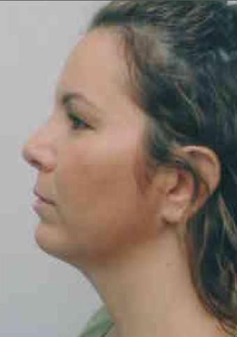 Chin Implant 724313