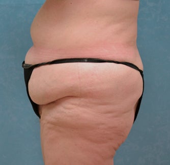 Circumferential Body Lift 857048