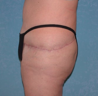Circumferential Body Lift 857048