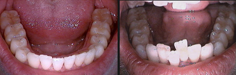 Invisalign after 109363