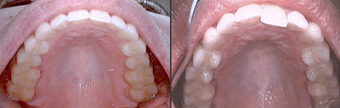Invisalign before 109363