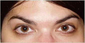 Botox after 748934