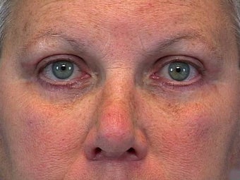 Blepharoplasty after 598971