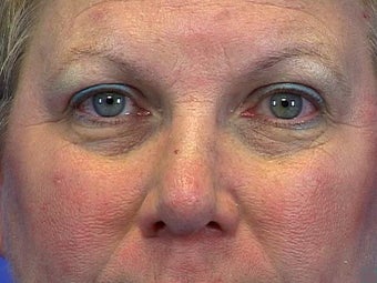Blepharoplasty before 598971