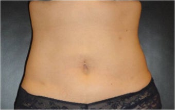 SmartLipo MPX after 686013