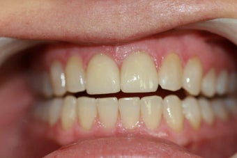 Upper anterior crowns to close gaps & Invisalign after 395296