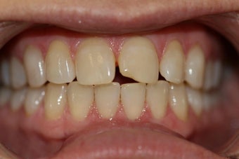 Upper anterior crowns to close gaps & Invisalign before 395296