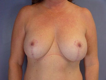 MASTOPEXY/AUGMENTATION after 280026