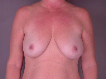 MASTOPEXY/AUGMENTATION before 280026