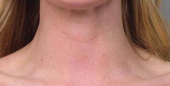 Botox after 967789