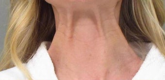 Botox before 967789