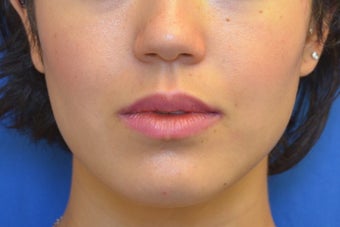 Botox (or Dysport) for Jaw Slimming after 1008142