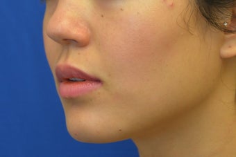 Botox (or Dysport) for Jaw Slimming 1008142