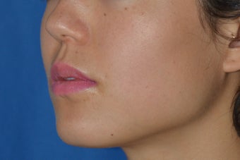 Botox (or Dysport) for Jaw Slimming 1008142