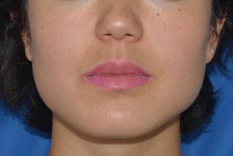 Botox (or Dysport) for Jaw Slimming before 1008142