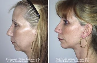 Face lift with chin implant side view before 6754