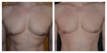 Young Male Treated for Male Breasts and Chest Definition before 1367289
