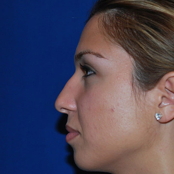Rhinoplasty before 1357421