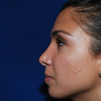 Rhinoplasty after 1357421