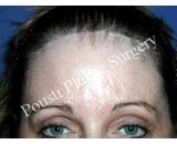 Forehead Lift after 921881
