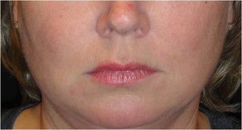 Juvederm after 686402